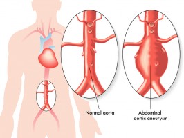 Abdominal Aortic Aneurysm (AAA)