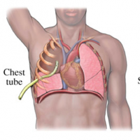 Chest tube